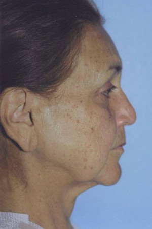 Facelift / Blepharoplasty Before & After Patient #4768