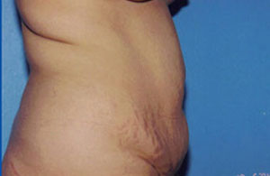 Tummy Tuck Before & After Patient #4869