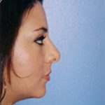 Rhinoplasty Before & After Patient #4803