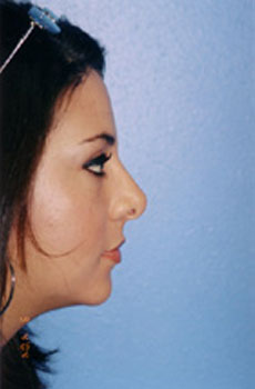 Rhinoplasty Before & After Patient #4803