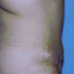 Tummy Tuck Before & After Patient #4869
