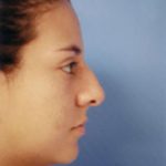 Rhinoplasty Before & After Patient #4803