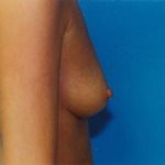 Breast Augmentation Before & After Patient #4934