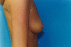 Breast Augmentation Before & After Patient #4934