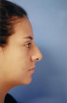 Rhinoplasty Before & After Patient #4803