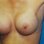 Breast Augmentation Before & After Patient #4934