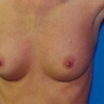 Breast Augmentation Before & After Patient #4934