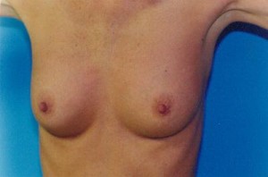 Breast Augmentation Before & After Patient #4934