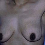 Breast Lift Before & After Patient #5026