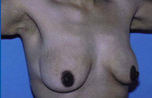 Breast Lift Before & After Patient #5026