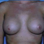Breast Augmentation Before & After Patient #4941