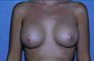 Breast Augmentation Before & After Patient #4941