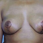 Breast Lift Before & After Patient #5035