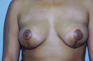 Breast Lift Before & After Patient #5035