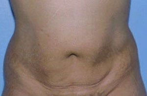 Tummy Tuck Before & After Patient #4874