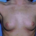 Breast Augmentation Before & After Patient #4941