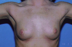 Breast Augmentation Before & After Patient #4941