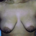 Breast Lift Before & After Patient #5035