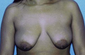 Breast Lift Before & After Patient #5035