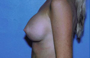 Breast Augmentation Before & After Patient #4941