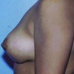 Breast Lift Before & After Patient #5035