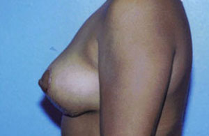 Breast Lift Before & After Patient #5035