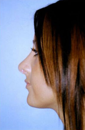 Rhinoplasty Before & After Patient #4812