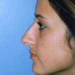 Rhinoplasty Before & After Patient #4812