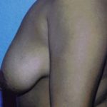 Breast Lift Before & After Patient #5035