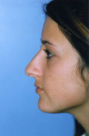 Rhinoplasty Before & After Patient #4812