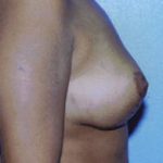 Breast Lift Before & After Patient #5035