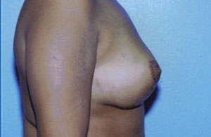 Breast Lift Before & After Patient #5035