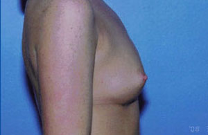 Breast Augmentation Before & After Patient #4941