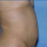 Tummy Tuck Before & After Patient #4874