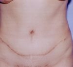 Tummy Tuck Before & After Patient #4881