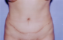 Tummy Tuck Before & After Patient #4881