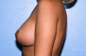 Breast Augmentation Before & After Patient #4948