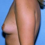 Breast Augmentation Before & After Patient #4948