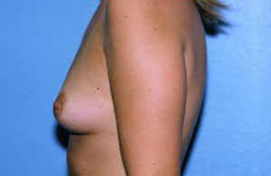 Breast Augmentation Before & After Patient #4948