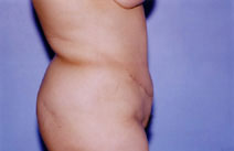 Tummy Tuck Before & After Patient #4881