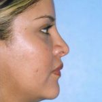 Rhinoplasty Before & After Patient #4821