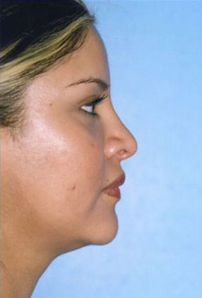 Rhinoplasty Before & After Patient #4821