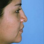 Rhinoplasty Before & After Patient #4821