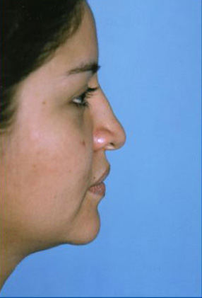 Rhinoplasty Before & After Patient #4821