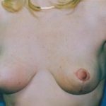 Breast Lift Before & After Patient #5042