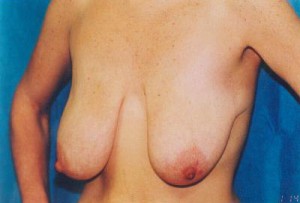 Breast Lift Before & After Patient #5042