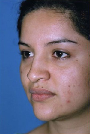 Rhinoplasty Before & After Patient #4821