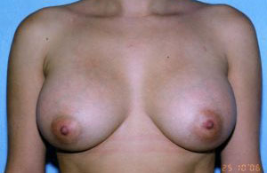 Breast Augmentation Before & After Patient #4953