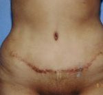 Tummy Tuck Before & After Patient #4889
