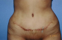 Tummy Tuck Before & After Patient #4889